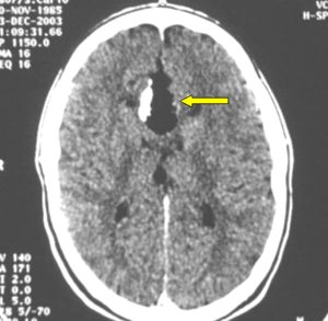 CT scan of a corpus callosum lipoma