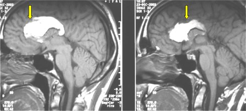 RMN di un lipoma