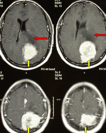 МРТ достаточно объемной менингиомы левой теменной области