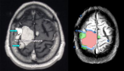 RMN funzionale di una caso di meningioma