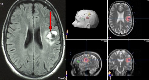 Cavernous Angioma