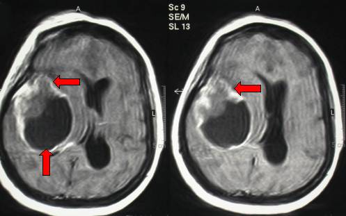 RMN di un glioblastoma multiforme temporale destro