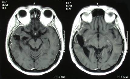 Quadro postoperatorio asportazione glioblastoma