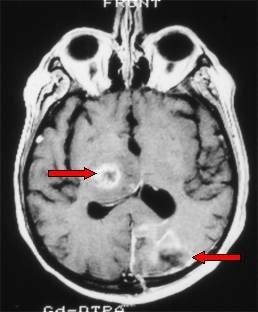 glioblastoma multiforme multicentrico