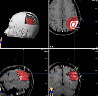 Studio al neuronavigatore di un oligodendroglioma