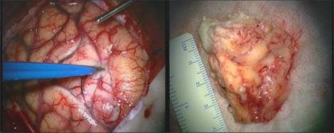 Demarcazione e asportazione dell'oligodendroglioma