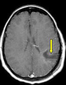 RMN postoperatoria rimozione dell'oligodendroglioma