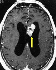 MRI image of an ependymoma