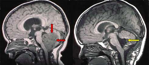 MRI features of a medulloblastoma