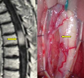 MRI displaying a dorsal hemangioblastoma