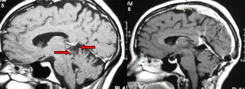 MRI of a low-grade astrocytoma