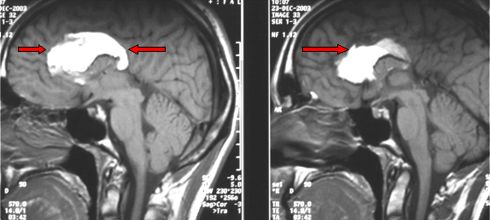 corpus callosum lipoma