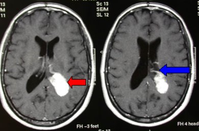 : papilloma del plesso corioideo intraventricolare 