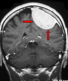 Mri Meningioma