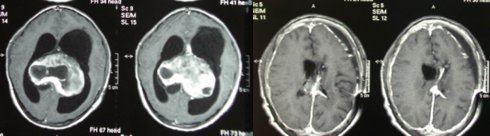 :astrocitoma pilocitico intraventricolare