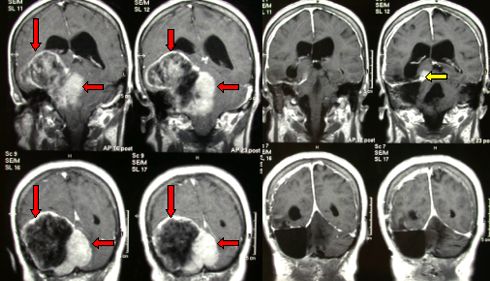 giant meningioma