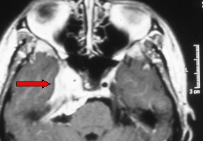 Meningioma sfenocavernoso