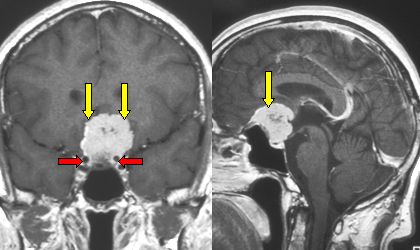 skull base meningioma