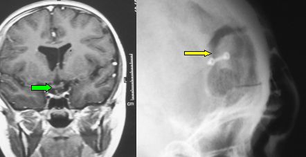 Pompili neurochirurgo clearance