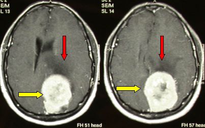 parietal meningioma