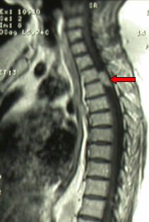 МРТ в боковой проекции наблюдается менингиома на уровне V спинного позвонка