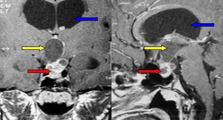 aspetto RMN di un craniofaringioma